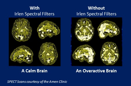 Irlen brain scans